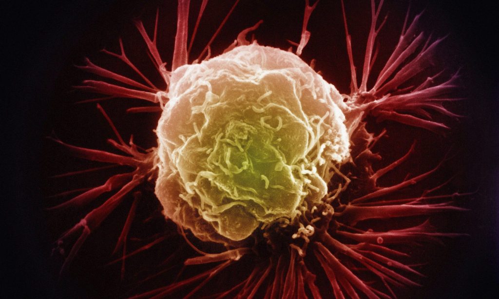 Breast cancer cell